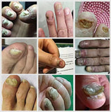 Ingrown Toenail Drops 60 ml Pack of 2 Beauty & Personal Care